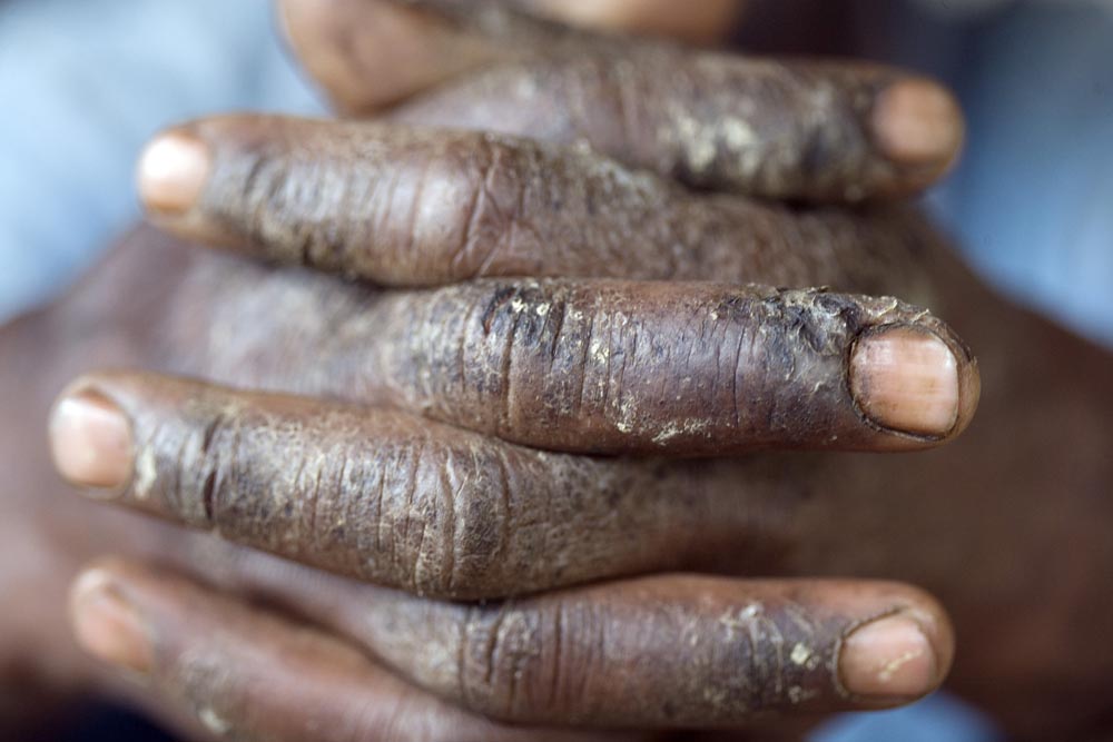 Acids and gasoline, used in the refining process, have damaged the hands of this "quimico", or chemist.