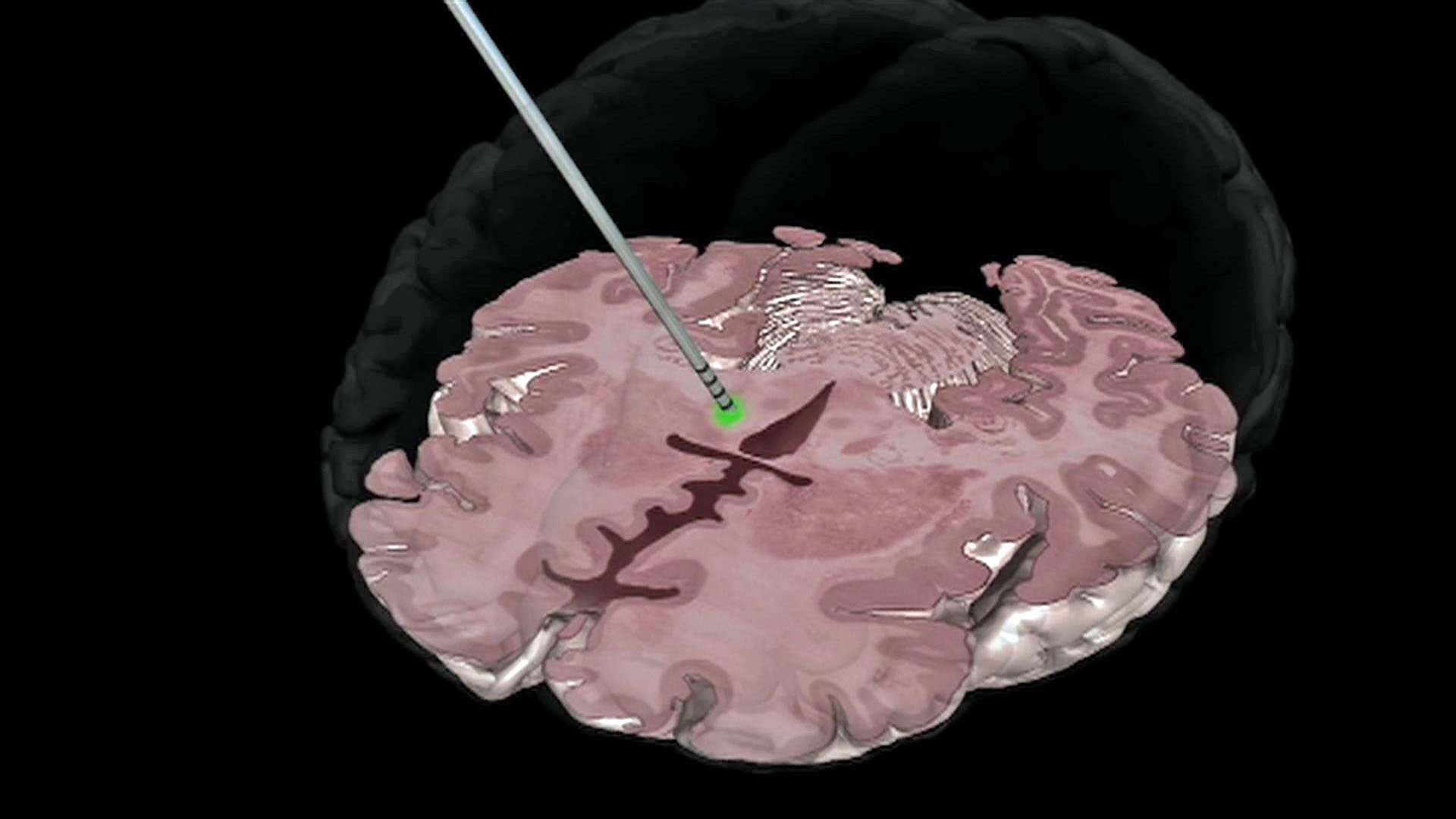 Deep brain stimulation