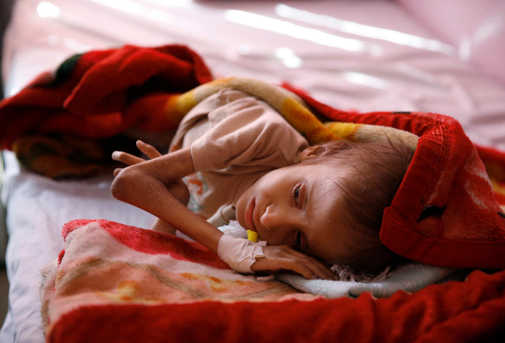 A malnourished child lies in a bed waiting to receive treatment at a therapeutic feeding centre in a hospital in Sanaa, Yemen