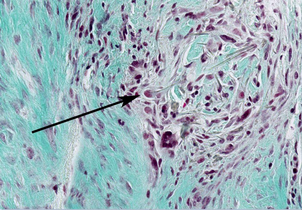 Immagine al microscopio di una fibra di amianto incastrata nella pleura