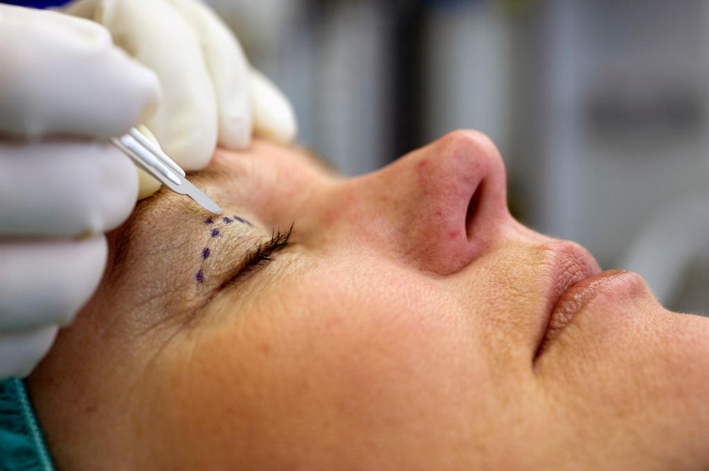 A picture of a woman being prepared for undergoing plastic surgery on her eyes