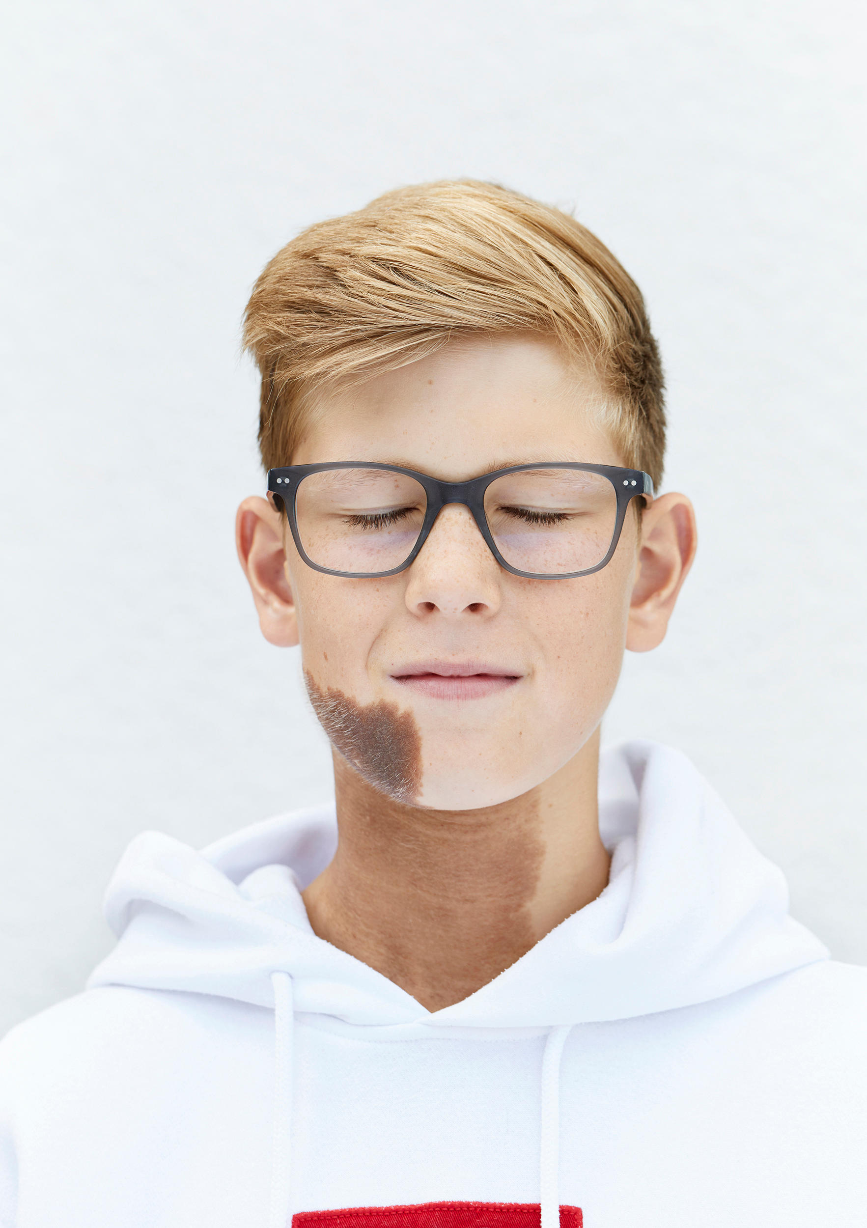 Retrato de un niño con una mancha en la parte inferior de la cara y el cuello