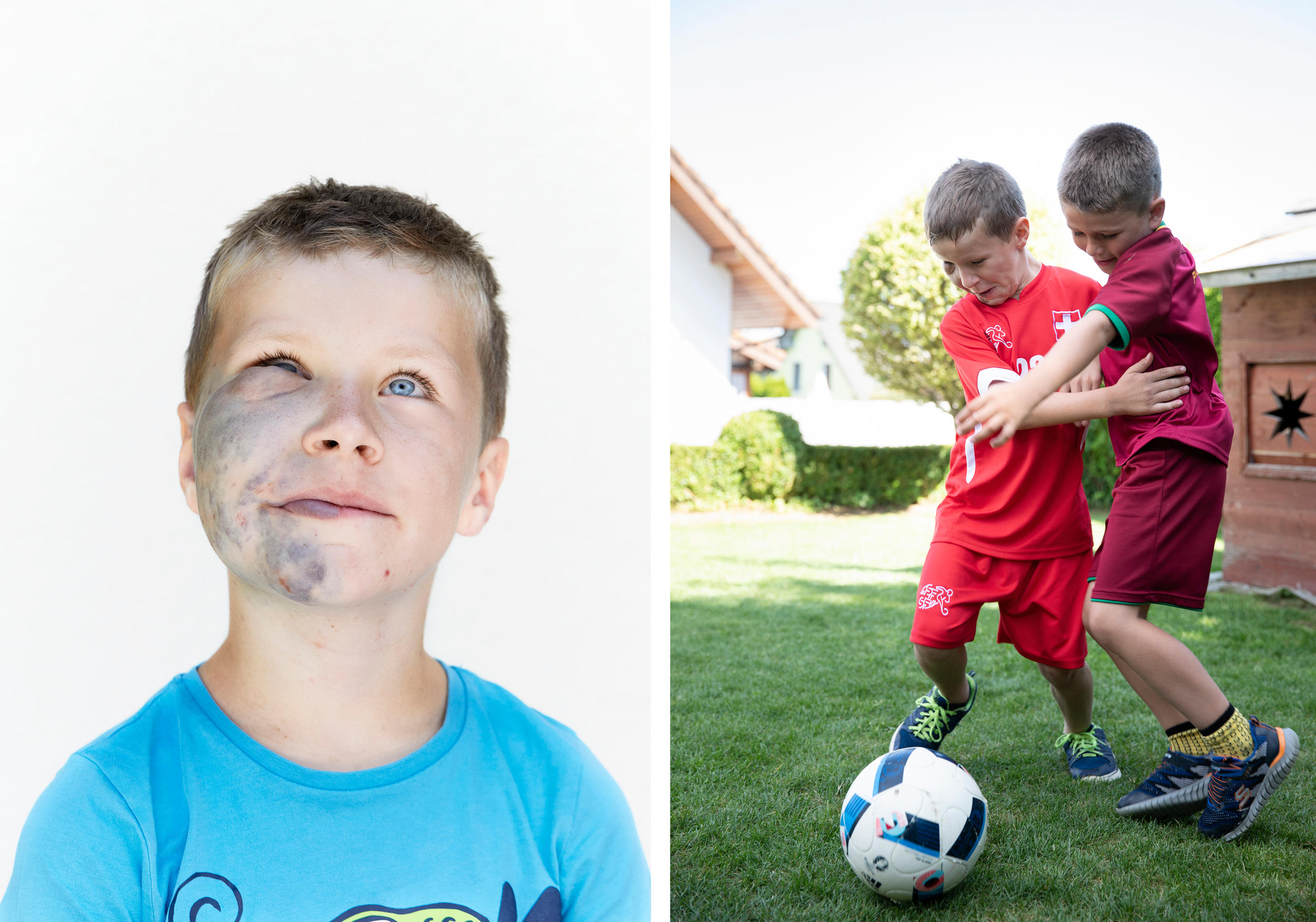 двойной портрет мальчика с дефектами кожи лица, улыбающимся и во время игры в футбол