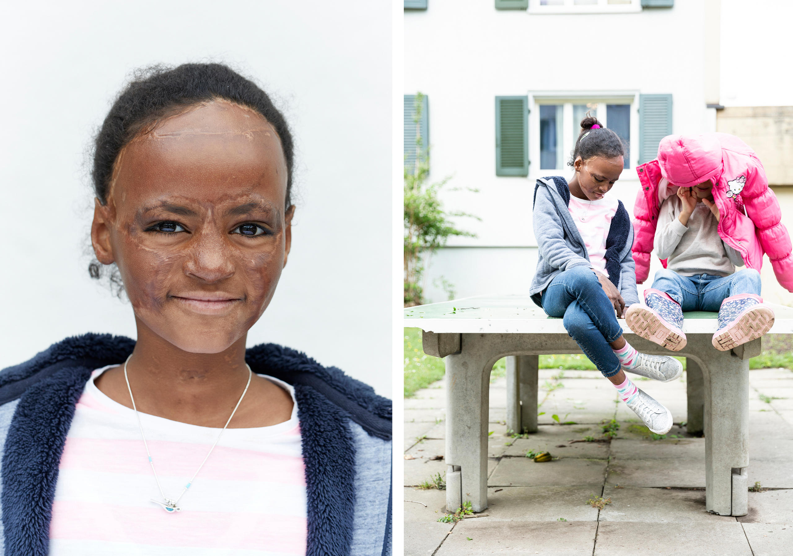 Pictures of a dark-skinned girl with burns to her face