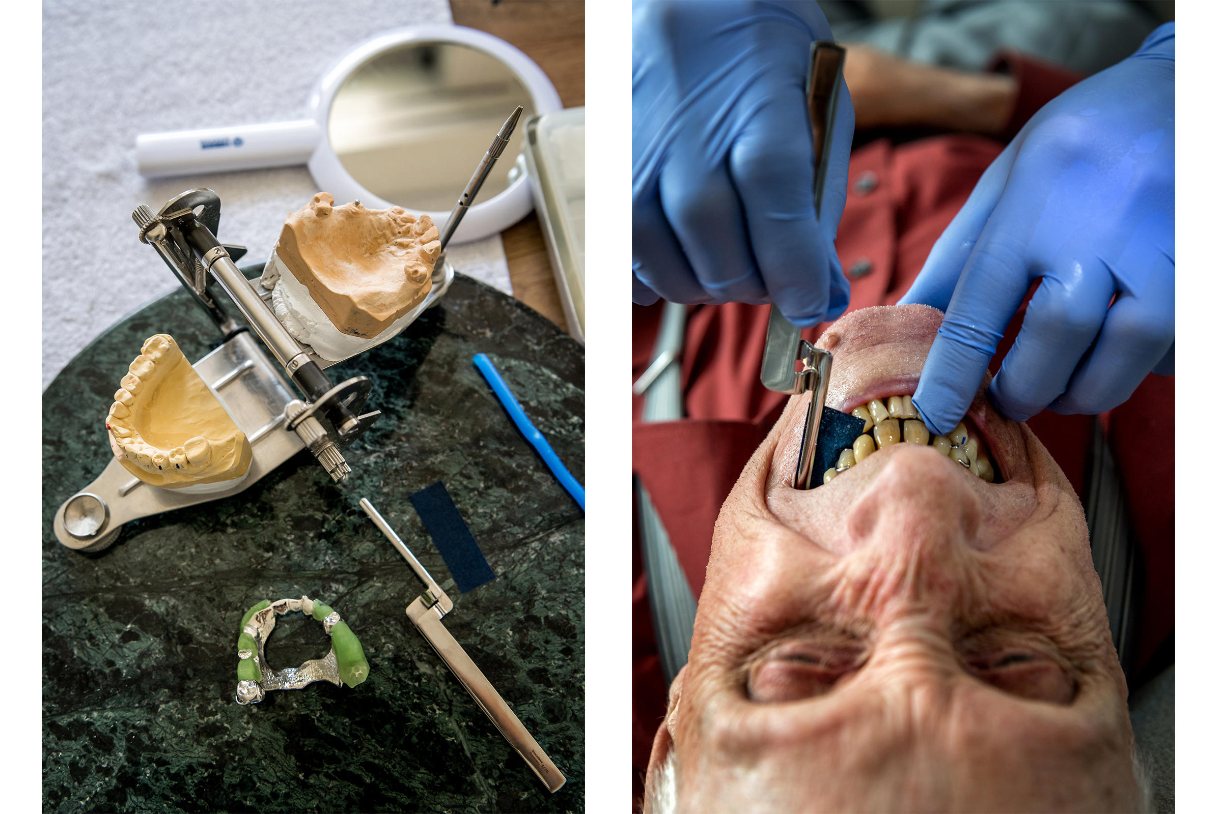 справа: дантист осматривает рот пожилого человека; слева: гипсовый отпечаток челюстей