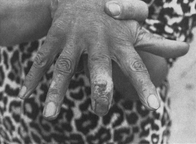 Hand durch Radium vesrstümmelt