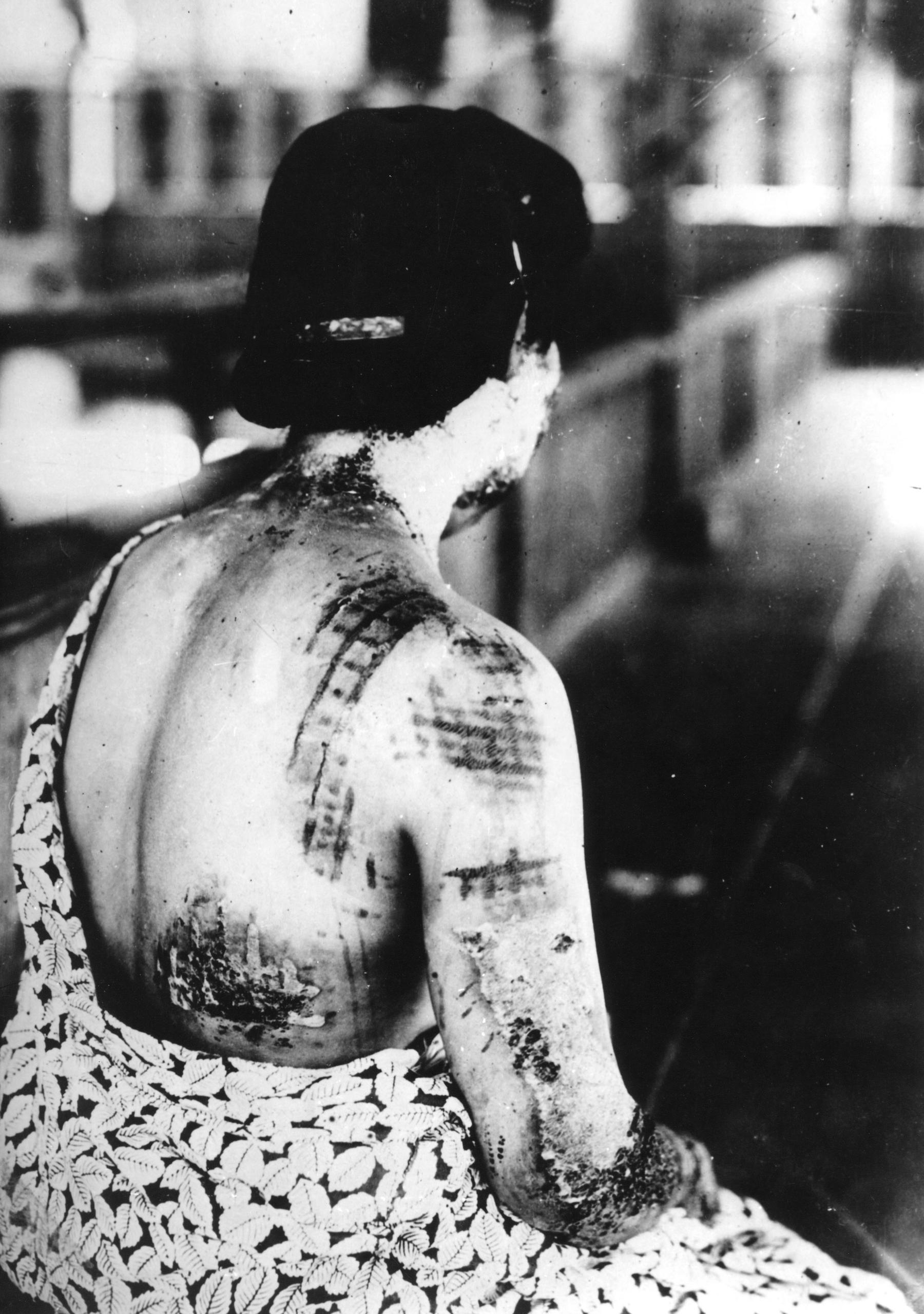 Frau mit eingebranntem Kimono-Muster auf Rücken und Armen