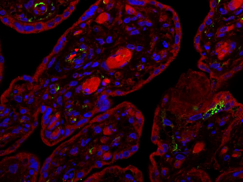 Placenta infectada por el coronavirus