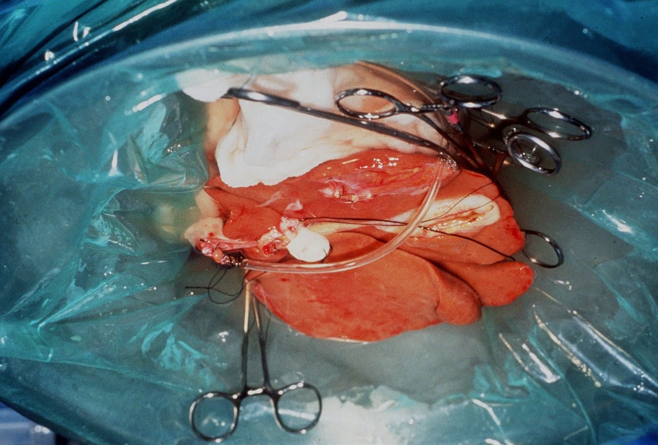 Foie prêt à être transplanté