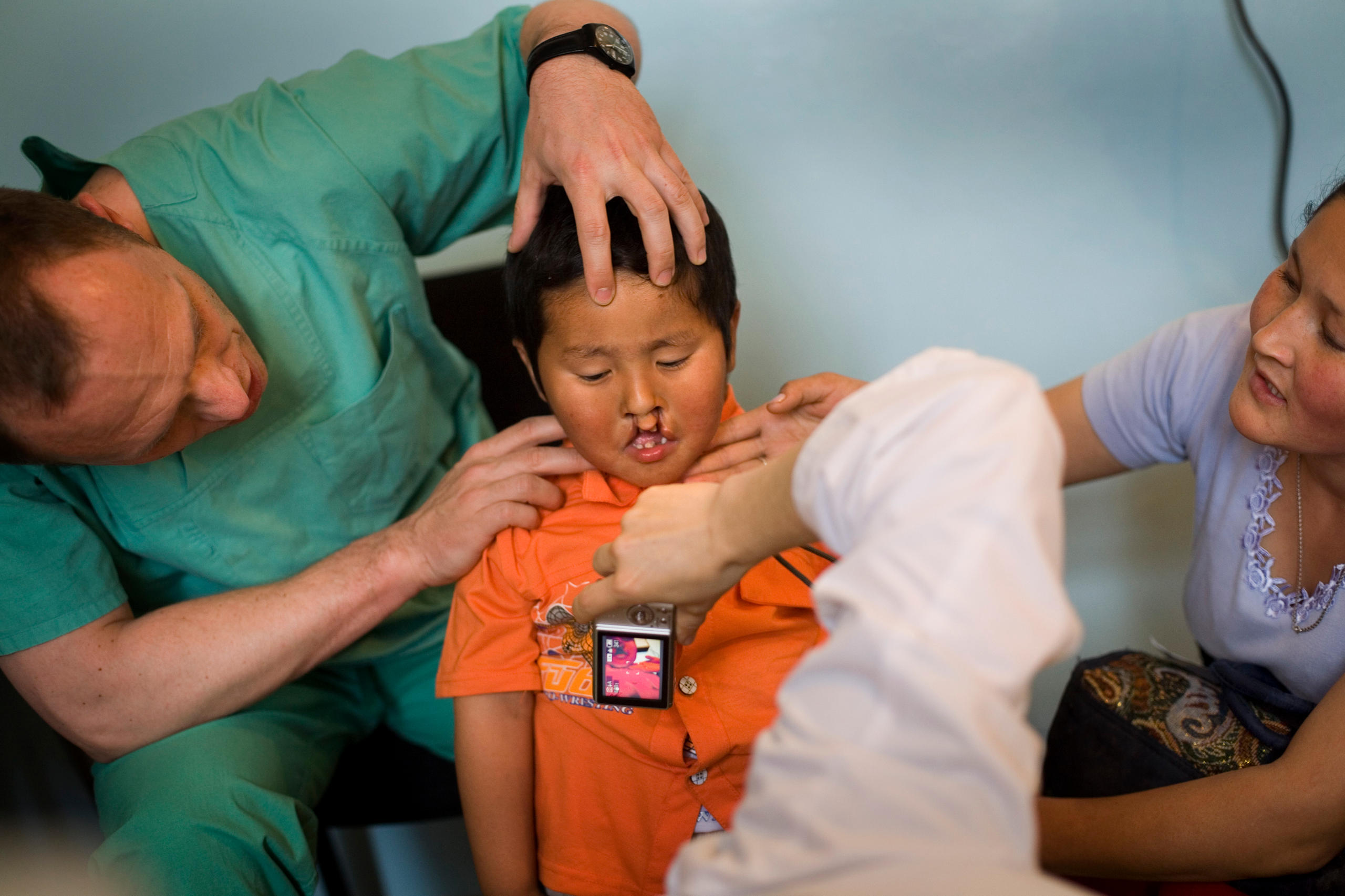 The interdisciplinary team of doctors and surgeonsare examing a patient with a two sided cleft lip and palate in Kyrgyzstan.