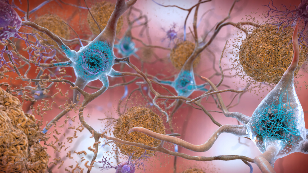 Illustration des Gehirns eines Alzheimerpatienten