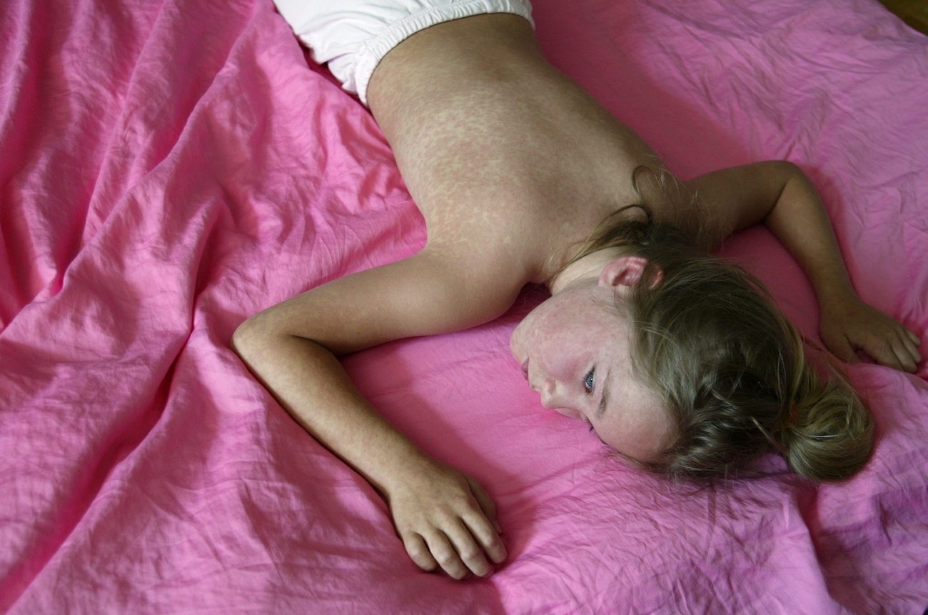 Girl with measles