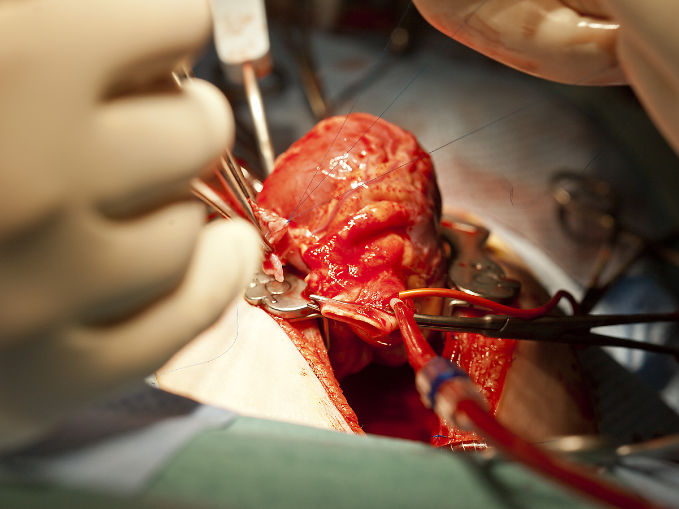 Swiss doctors transplant heart after record-long transport