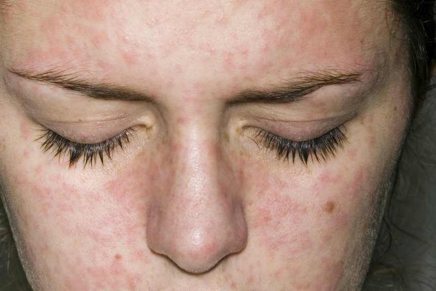 はしかの症状が出た女性の顔写真