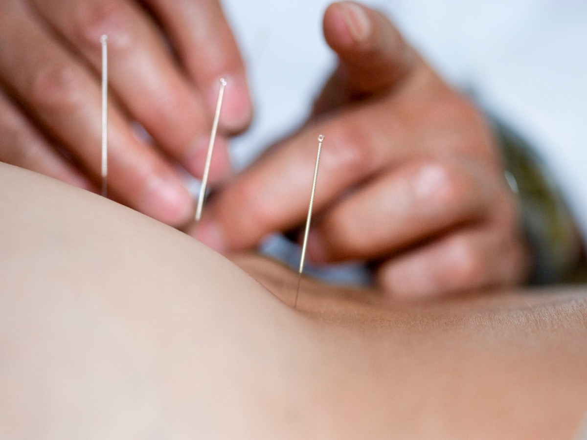 Swiss insurance to continue covering acupuncture and homeopathy Swiss insurance to continue covering acupuncture and homeopathy