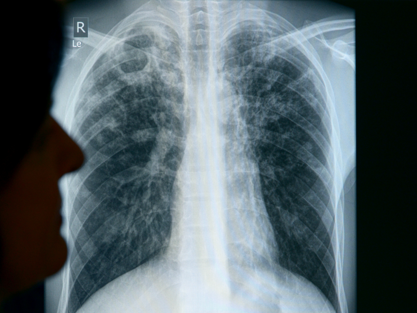 Tuberculosis cases on the rise in Switzerland