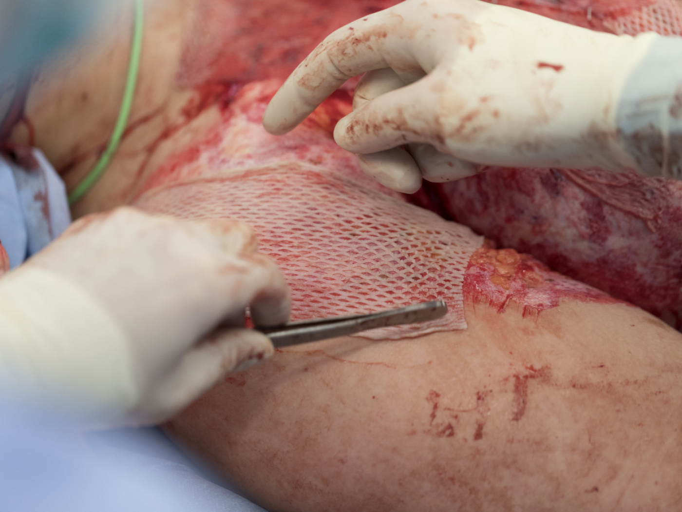 Gender difference in burn injuries surprises researchers