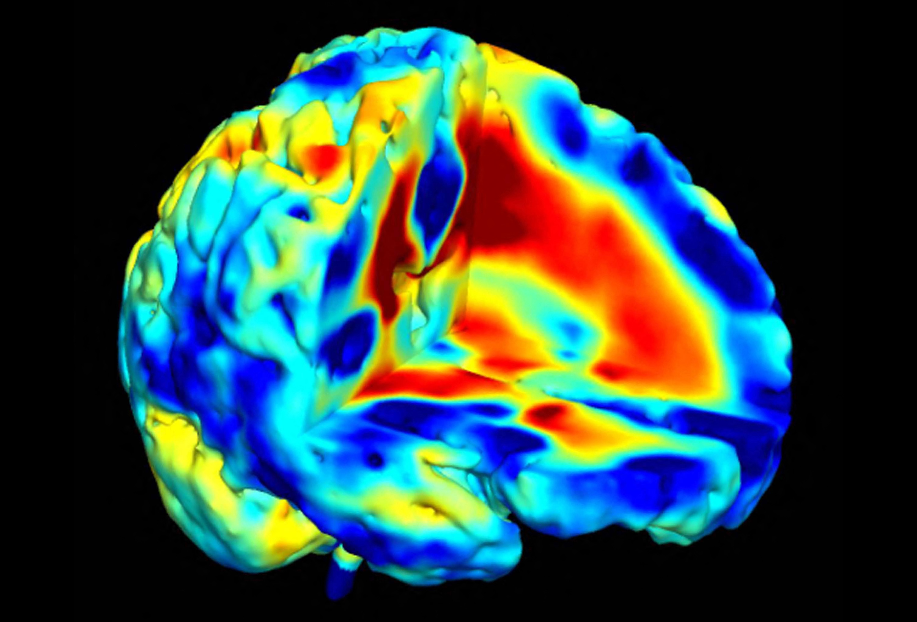 Schizophrenia Brain of MRI scan data for child onset schizophrenia showing areas of brain growth and loss of tissue .
