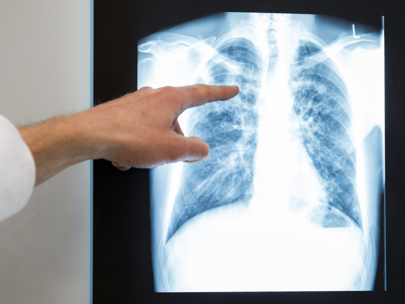 Tuberculosis cases in Switzerland at their highest level since 2018