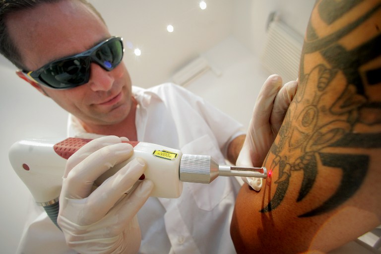 Laser Tattoo Removal Equipment Upgrade in Auckland is Better for Customers   Sacred Laser