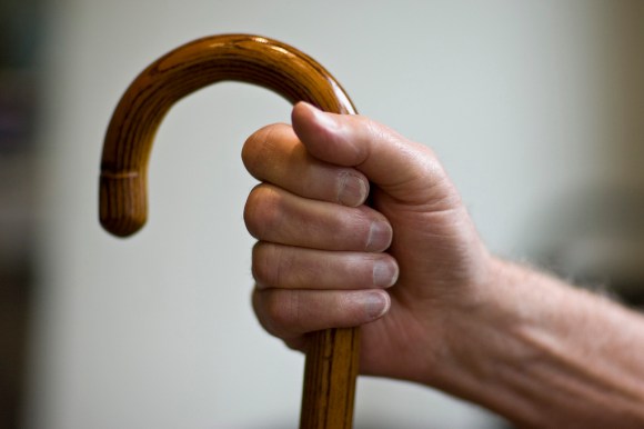 Arthritic hand