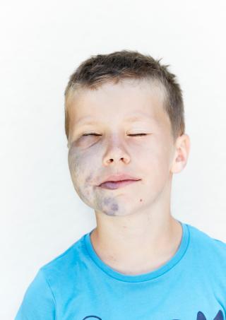 Retrato de un ni´no con lesiones en la mitad del rostro