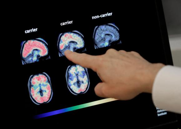PET brain scan image