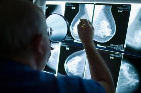 Un radiólogo examina radiografías para detectar signos de cáncer de mama.