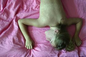 Una muchacha con el dorso desnudo lleno de ronchas de sarampión, extendida boca abajo sobre una cama.