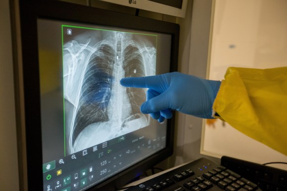 A doctor studies an x-ray of the lungs of a patient