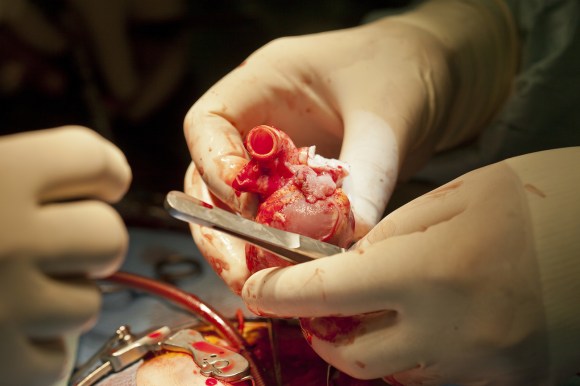 Il trapianto di un cuore a un bambino.