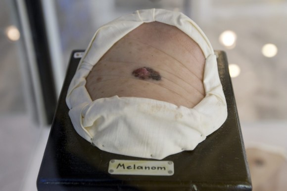 A model exhibit of a melanoma
